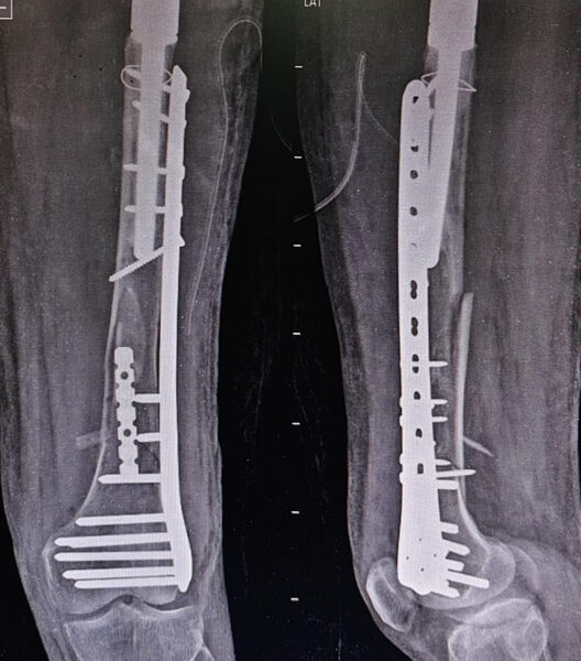 custom-made-tumour-prosthesis